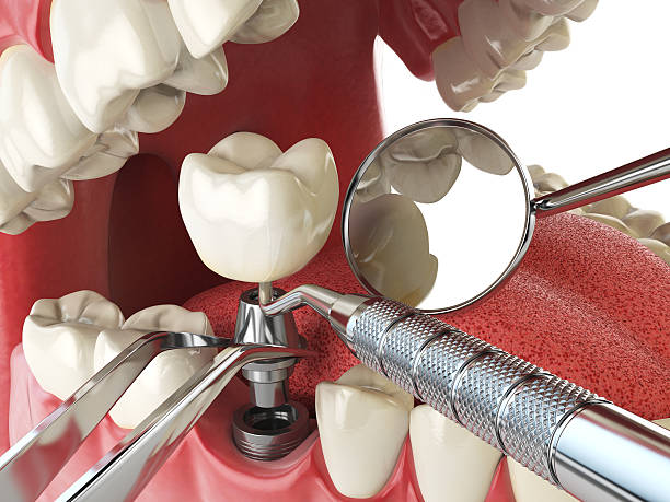Best Chipped Tooth Repair Near Me  in Lyndhurst, VA